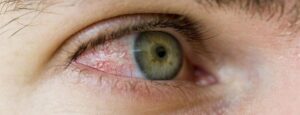 Lee más sobre el artículo Tratamiento de lesiones Oculares