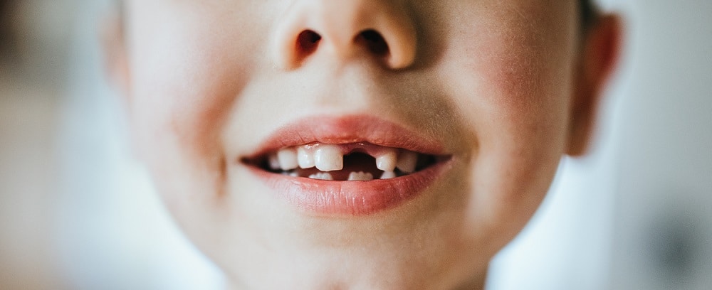 Lee más sobre el artículo Caída o Pérdida de dientes en niños y adultos